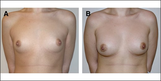 (A) Preoperative 26-year-old patient of normal weight, BMI = 21.3 kg/m2, pinch test < 2 cm. (B) One year post operation, 275-cc round prosthesis, dual-plane technique, lower hemiperiareolar access, 1 bra size increase; delta Rasch 27 (preoperative score 44; postoperative score 71). BMI, body mass index.