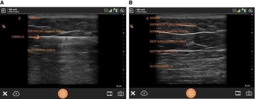Ultrasound view of gluteal anatomy with layers labeled (dermis, superficial subcutaneous space, superficial gluteal fascia, deep subcutaneous space, deep gluteal fascia, and gluteal muscle) with (A) and without (B) the infiltrating cannula.