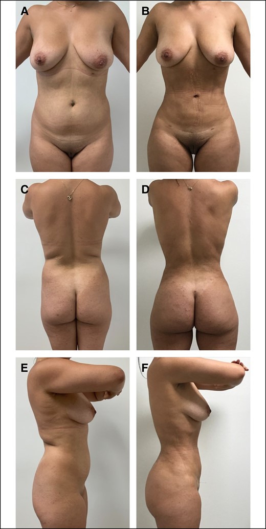 A 23-year-old female patient who is 6 months postoperative liposuction and ultrasound-guided fat transfer to buttocks and hips. She had a BMI of 26.1 kg/m2 and the total fat transferred was 720 mL. (A) Preoperative anterior view, (B) postoperative anterior view, (C) preoperative posterior view, (D) postoperative posterior view, (E) preoperative lateral view, and (F) postoperative lateral view.