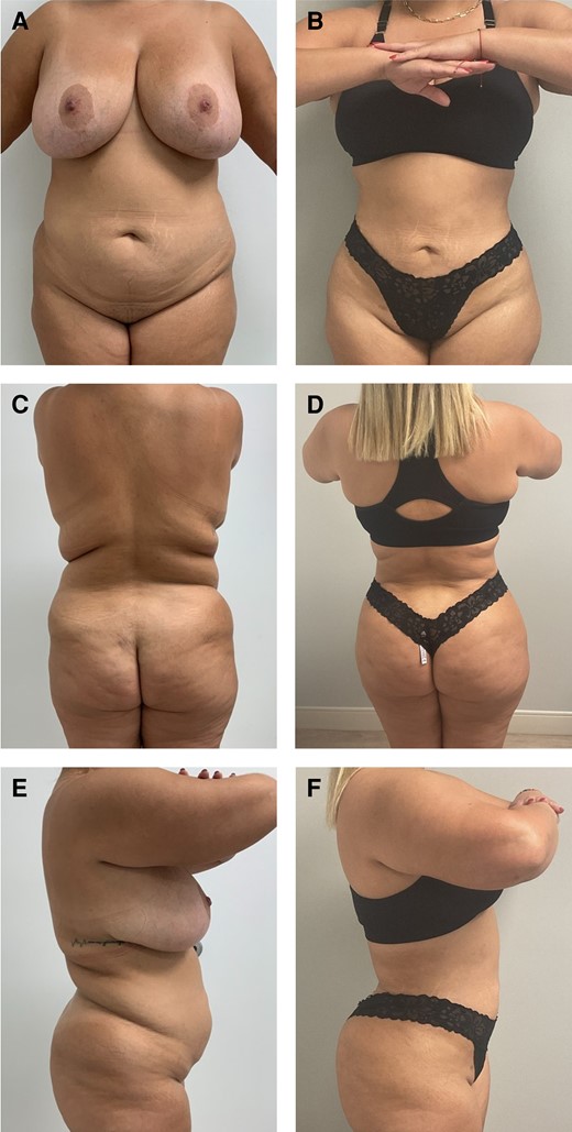 A 34-year-old female patient who is 2 years postoperative liposuction and ultrasound-guided fat transfer to buttocks and hips. She had a BMI of 29.5 kg/m2 and the total fat transferred was 780 mL. (A) Preoperative anterior view, (B) postoperative anterior view, (C) preoperative posterior view, (D) postoperative posterior view, (E) preoperative lateral view, and (F) postoperative lateral view).