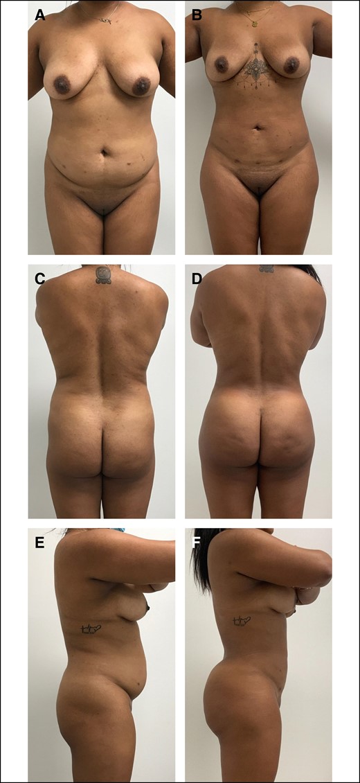 A 33-year-old female patient who is 8 months postoperative liposuction and ultrasound-guided fat transfer to buttocks and hips. She had a BMI of 26.1 kg/m2 and the total fat transferred was 840 mL. (A) Preoperative anterior view, (B) postoperative anterior view, (C) preoperative posterior view, (D) postoperative posterior view, (E) preoperative lateral view, and (F) postoperative lateral view.