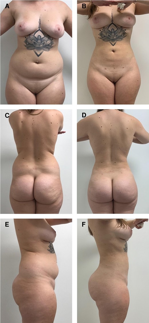 A 21-year-old female patient who is 6 months postoperative liposuction and ultrasound-guided fat transfer to buttocks and hips. She had a BMI of 27.4 kg/m2 and the total fat transferred was 900 mL. (A) Preoperative anterior view, (B) postoperative anterior view, (C) preoperative posterior view, (D) postoperative posterior view, (E) preoperative lateral view, and (F) postoperative lateral view.