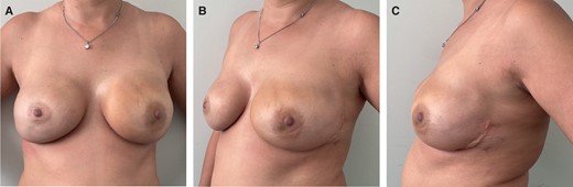 A 56-year patient who underwent bilateral nipple-sparing mastectomies (therapeutic on the left side and risk-reducing on the right side) with access at the inframammary fold and immediate direct-to-implant prepectoral reconstruction with micro polyurethane foam–coated anatomic implants (420 cc; width 13.8 cm). The patient underwent postmastectomy radiotherapy on the left side. The patient is shown 6 months postoperatively in (A) front, (B) left oblique, and (C) left side views.