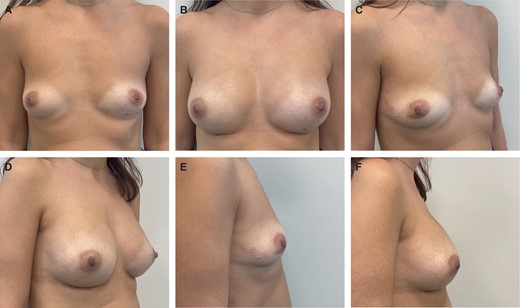 A 30-year patient who underwent risk-reducing bilateral nipple-sparing mastectomies with access at the inframammary fold and immediate direct-to-implant prepectoral reconstruction with micro polyurethane foam–coated anatomic implants (335 cc; width 12.5 cm). Preoperative (A, C, E) and 6-month postoperative (B, D, F) photographs are shown in front, right oblique, and right side views.