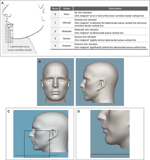 (A) Allergan Chin Retrusion Scale (ACRS) for photographic assessment of participant chin retrusion scores. A schematic illustration of rendering of a 2D image from a 3D participant image is shown as follows: (B) The 3D image is registered to the center of a 3D grid following the Frankfort plane orientation. The registered 3D image could be rotated to fixed views in 3D space (Appendix, available online at www.aestheticsurgeryjournal.com). (C) The view of the 3D image is rotated to the participant's left profile. The software adds a fixed millimeter scale to the 3D space at a fixed position in the grid, then creates a 2D image of fixed side. A crop box (black box) is placed on the bottom of the 2D image and adjusted horizontally to approximately center the chin within the frame. (D) The image is cropped to create the final 2D image for the evaluating investigator to assess. 2D, 2-dimensional; 3D, 3-dimensional. *Chin midpoint: the midpoint between the labiomental sulcus and the inferior point of the chin. Panel A Reproduced with permission from Sykes et al., 2016.5