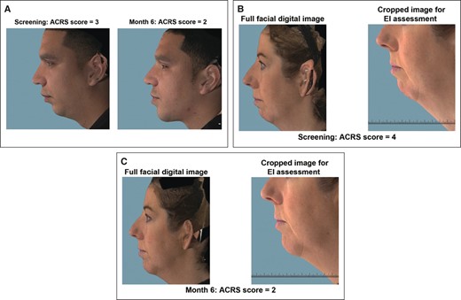 Representative participant photographs. (A) The 32-year-old representative male participant had an EI-rated ACRS score of 3 (severe) at baseline and 2 (moderate) at Month 6 after treatment with VYC-20L for chin retrusion. The 43-year-old representative female participant had an EI-rated ACRS score of 4 (extreme) at baseline (B) and 2 (moderate) at Month 6 after treatment with VYC-20L for chin retrusion (C). For panels in (A) and left panels in (B) and (C), images show the 2-dimensional rendering of the chin profile generated from 3-dimensional full facial digital images. Right panels in (B) and (C) show cropped photographs that include only the lower face, evaluated by the EI to determine ACRS rating. Photographs were assessed to ensure consistent head positioning across visits. ACRS, Allergan Chin Retrusion Scale; EI, evaluating investigator.