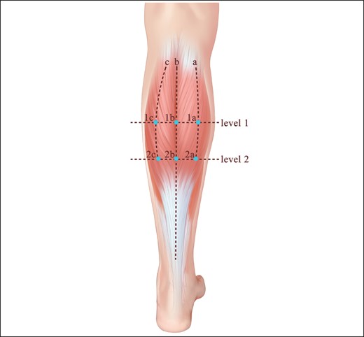 Illustration of the ultrasonographic detection of calves’ thickness. An ultrasound probe was placed at these 6 sites. Subcutaneous fat, gastrocnemius, and soleus muscle thicknesses were recorded at each site. The midline of the calf was defined as Line b. Line a was defined as the halfway point between the distance from the medial border of the gastrocnemius to Line b. Line c was defined as the halfway point between the distance from the lateral border of gastrocnemius to Line b. Levels 1 and 2 represented the one-quarter and one-half heights of the calf. Reproduced with permission from Chong et al.14