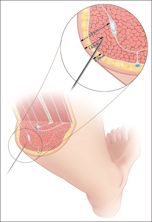 Recommended injection depth of gastrocnemius based on preinjection ultrasound data.