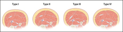 Schematic diagram of the 4 types of gastrocnemius muscle in cross-sectional views. Type I, the double bulge type, characterized by 2 muscle prominent bulges. Type II, the mono bulge, intermediate dominant type, characterized by a single bulge in the middle. Type III, the mono bulge, medial dominant type, characterized by a single bulge in the medial head. Type IV, the mono bulge, lateral dominant type, characterized by a single bulge in the lateral head. Reproduced with permission from Chong et al.14