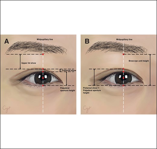 Schematic drawing of periocular region. The red circles represent the pupillary center and the vertical corresponding points of the pupillary center on the lower margin of the eyebrow, the upper eyelid crease, the upper palpebral margin, and the lower palpebral margin. The left image (A) shows an in-fold double eyelid with pretarsal show, palpebral aperture height, and upper lid show identified, and the right image (B) shows an out-fold double eyelid with pretarsal show, palpebral aperture height, and brow-eye unit height identified.