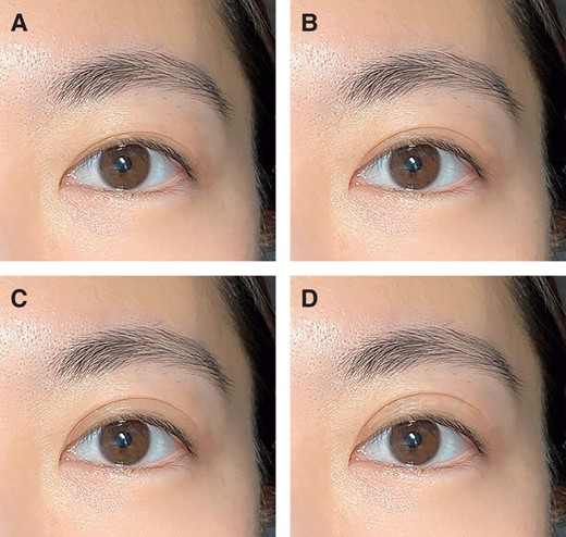 Images with in-fold morphology but varied upper eyelid crease heights. The original image features a 27-year-old female with a pretarsal show of (A) 1 mm, (B) 2 mm, (C) 3 mm, and (D) 4 mm.