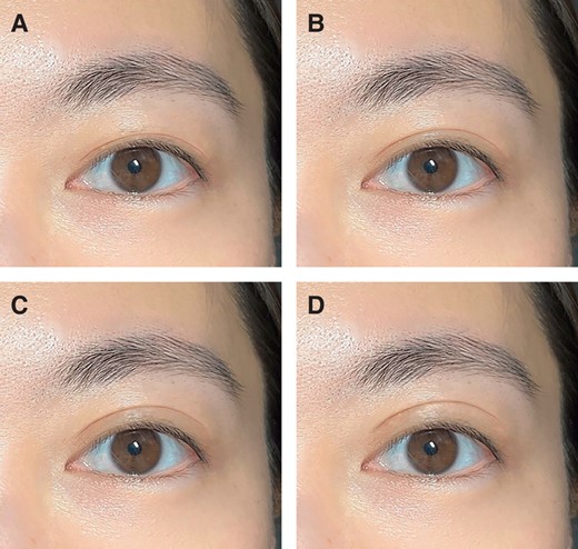 Images with out-fold morphology but varied upper eyelid crease heights. The original image features a 27-year-old female with a pretarsal show of (A) 1 mm, (B) 2 mm, (C) 3 mm, and (D) 4 mm.