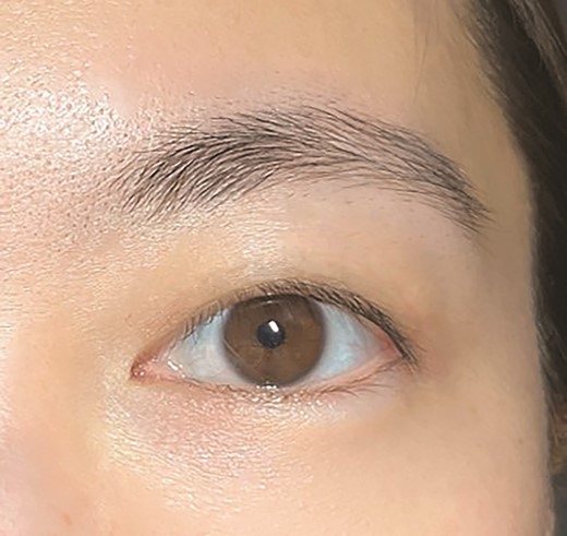 The image with single eyelid. The original image features a 27-year-old female.