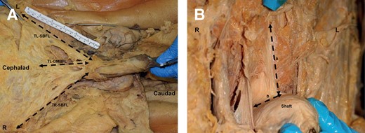 Photographs showing the measurements taken on the suspensory ligaments of the penis. (A) Dimensions of the fundiform ligament: TL-SBFL (total length of the left superficial bundle of the fundiform ligament), TR-SBFL (total length of the right superficial bundle of the fundiform ligament), and TL-DMBFL (total length of the deep median bundle of the fundiform ligament). (B) Dimensions of the suspensory ligament proper: a, height; b, length. L, left side; R, right side.