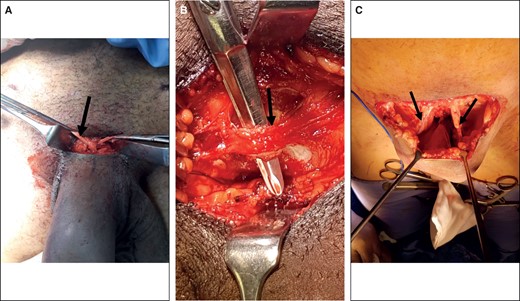 Intraoperative procedures during the division of the suspensory ligament system of the penis to correct a buried penis. (A) Extending the SPL by the palmaris longus tendon. The palmaris longus tendon (arrow) is tunneled beneath a symphysis pubis periosteum and through a hole in the stump of the suspensory ligament of the penis. (B) The development of the pubic symphysis flap (arrow) before division of the superior attachment to the perichondrium of the pubic symphysis to create an inferiorly pedicled flap. (C) The deep median bundle of the fundiform ligament (arrows) spared to provide the residual support for anterior movement of the penis required for an effective erection after fixation of the flap to the SPL. SPL, suspensory penile ligament.