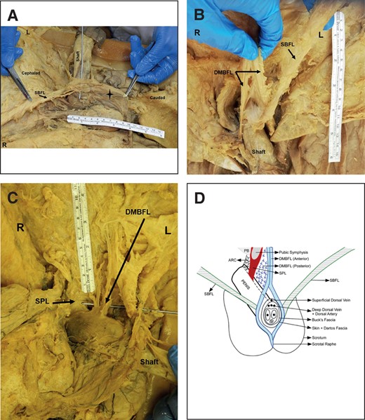 Orientation and topography of the suspensory ligaments of the penis. (A) The SBFL forms a sling around the shaft of the penis and continues into the scrotum as the median raphe ligament (star). (B) The anterior fibers of the DMBFL split into right and left bundles surrounding the penile shaft. (C) The DMBFL splits into anterior and posterior fiber bundles with the anterior fiber bundles fusing the SBFL and the posterior fiber bundle inserting into the deep fascia of the dorsum of the penis, respectively. (D) The topography and divisions of the suspensory ligament complex of the penis. ARC, arcuate ligament; DMBFL, deep median bundle of the fundiform ligament; L, left side; PB, pubic bone; SBFL, superficial bundle of the fundiform ligament; SPL, suspensory penile ligament; R, right side.