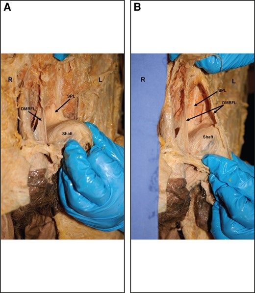 Photographs showing the DMBFL and the SPL. (A) Right split half of the DMBFL and the SPL. (B) Splitting of the DMBFL and midline and deep SPL. DMBFL, deep median bundle of the fundiform ligament; L, left side; R, right side; SPL, suspensory penile ligament.