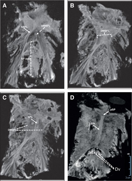 MRI showing a series of coronal plane images of the suspensory ligament system of the penis from superficial to deep (anterior to posterior in anatomical terminology) (A-D). (A) The distal portions of the fundiform ligament showing the SBFL (laterally) and the DMBF (midline) inserting on and encircling the penile shaft (SP). (B) The spread of the DMBFL. (C) The DMBFL splits towards the penile shaft and the SPL (midline) fuses with the fascia of the penis. (D) The SPL arises from the perichondrium of the pubic symphysis and inserts on the deep fascia of the penis (Buck's fascia) above the deep dorsal vasculature of the penis. DMFBL, deep median bundle of the fundiform ligament; Dv, deep dorsal vasculature; pSP, perichondrium of the pubic symphysis; SPL, suspensory penile ligament; SBFL, superficial bundle of the fundiform ligament; SP, penile shaft. Scale bar = 3 cm in (D) applies to all images.