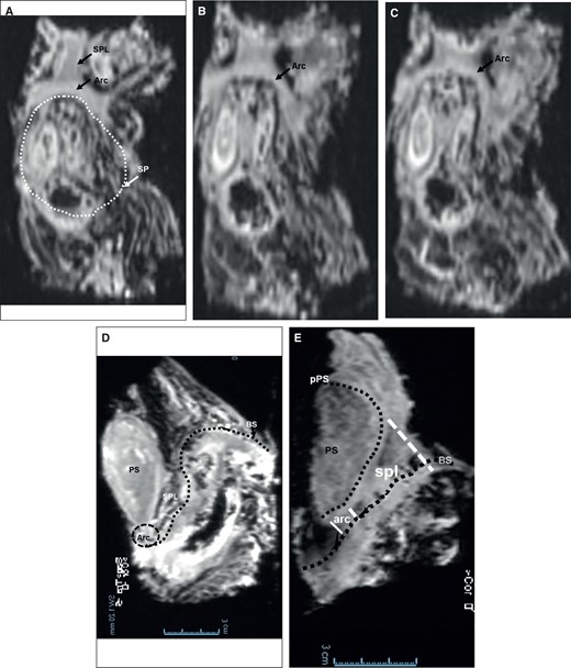 MRI showing a series of coronal plane images of the arcuate ligament from superficial to deep (anterior to posterior in anatomical terminology) (A-C) and the sagittal plane images of both the SPL and the arcuate ligament. (D, C). (A) The SPL and the arcuate ligament appear to fuse above the penile shaft (SP). (B, C) The arcuate ligament above the erectile bodies (root/shaft) of the penis. (D, E) The SPL and the arcuate ligament in the sagittal plane showing their proximal origins from the perichondrium of the pubic symphysis and distal insertions on the Buck's fascia of the penis. Arc, arcuate ligament; BS, Buck's fascia; PS, pubic symphysis; pPS, perichondrium of the pubic symphysis; SPL, suspensory penile ligament; SP, penile shaft. Scale bar = 3 cm in (D, E) applies to all images.
