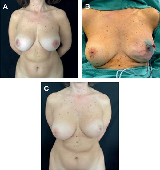 (A) Preoperative image of a 45-year-old female patient who underwent a subglandular breast augmentation, classified as a thick patient. (B) Left NSM and immediate prepectoral reconstruction with textured anatomical implants with full ADM coverage. (C) Postoperative result at 2 years. ADM, acellular dermal matrix; NSM, nipple-sparing mastectomy.