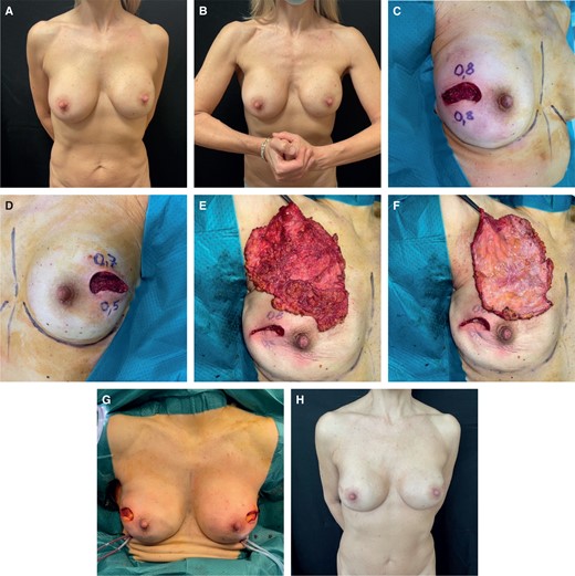 (A) Preoperative image of a 60-year-old female patient in static position who underwent a subglandular breast augmentation. (B) Patient in dynamic position. (C) Intraoperative MFT < 1 cm right side, ICG angiography showed good mastectomy flap perfusion. (D) Intraoperative MFT < 1 cm left side, ICG angiography showed good mastectomy flap perfusion. (E) Right mastectomy specimen. (F) Right anterior capsule removed together with the gland. (G) Intraoperative view of prepectoral reconstruction with PU implants. (H) Postoperative result at 1 year. ICG, indocyanine green; MFT, mastectomy flap thickness; PU, polyurethane.