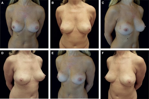(A) Preoperative frontal view image of a 58-year-old female patient who underwent subglandular breast augmentation with a calcified capsule, MFT < 1 cm. ICG angiography showed good mastectomy flap perfusion. (B) 14 months postoperative frontal view, after bilateral NSM with total capsulectomy and prepectoral reconstruction with textured anatomical implants with full ADM coverage. (C) Preoperative left oblique view. (D) 14 months postoperative left oblique view. (E) Preoperative right oblique view. (F) 14 months postoperative right oblique view. ADM, acellular dermal matrix; ICG, indocyanine green; MFT, mastectomy flap thickness; NSM, nipple-sparing mastectomy.