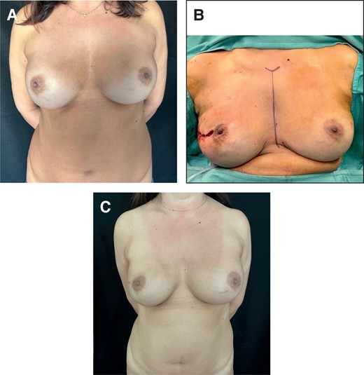 (A) Preoperative image of a 47-year-old female patient who underwent submuscular breast augmentation, MFT > 1 cm. (B) Intraoperative view of prepectoral immediate implant conversion with anatomical PU-covered implant after right NSM. (C) Postoperative result at 12 months. MFT, mastectomy flap thickness; NSM, nipple-sparing mastectomy; PU, polyurethane.