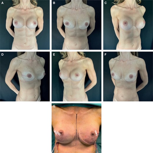 (A) Preoperative frontal view of a 49-year-old female patient who underwent submuscular breast augmentation with bilateral capsular contracture, MFT < 1 cm. (B) 1 year postoperative frontal view of submuscular reconstruction, she shows recurrent capsular contracture. (C) Preoperative left oblique view. (D) 1 year postoperative left oblique view. (E) Preoperative right oblique view. (F) 1 year postoperative right oblique view. (G) Intraoperative view of submuscular breast reconstruction. MFT, mastectomy flap thickness. NSM, nipple-sparing mastectomy.