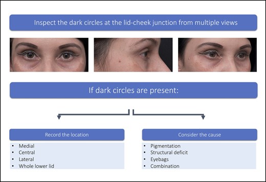 Inspection of the lid-cheek junction. Patient images reproduced from Liew and DeSilva (with permission from Georg Thieme Verlag KG).15
