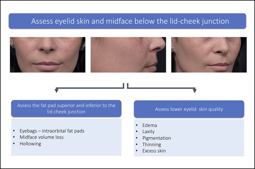 Assess midface and lower eyelid skin quality. Patient images reproduced from Liew and DeSilva (with permission from Georg Thieme Verlag KG).15