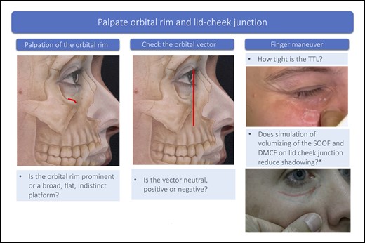 Palpation of the orbital rim and lid-cheek junction. Underlying bone tissue image, sourced from Mendelson and Wong.27 *Finger on midface pushing cephalad toward the lid-cheek junction, simulating the effect on volumizing the medial SOOF on lid-cheek junction. DMCF, deep medial cheek fat; SOOF, suborbicularis oculi fat; TTL, tear trough ligament.