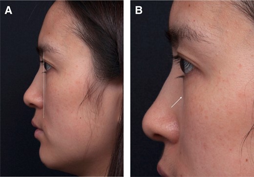 Classification Group 1b. A 25-year-old female displaying typical features including a negative orbital vector (A) and pseudo eye bags (B, arrow).