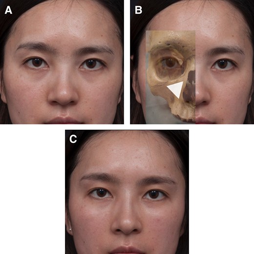 (A) The same Group 1b 25-year-old female shown in Figure 5 presented with dark lower lid circles. (B) The lower eyelid dark circle is due to structural retrusion of the maxilla. The triangle shows the position of the underlying structural bony deficit and indicates the optimal placement of filler in the medial suborbicularis oculi fat pad and deep medial cheek fat pad to achieve correction. (C) Three months post injection with a small volume of soft hyaluronic acid filler, showing an elevation and effacement of the lid-cheek junction and improved appearance of dark circles without actual treatment of the lower eyelid region.