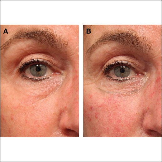 Classification Group 2a. (A) A 54-year-old female exhibiting depression across all segments of the lid-cheek junction. (B) The same patient immediately following filling of the medial suborbicularis oculi fat pad and deep medial cheek fat pad with filler, showing elevation and effacement of the central lid-cheek junction. Image reproduced from Liew and DeSilva, with permission from Georg Thieme Verlag KG.15