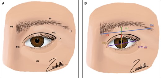 Anthropometric (A) points and (B) measurements. EAx, eyebrow axis; EFH, eye fissure height; EFW, eye fissure width; EP, eyebrow peak; IAx, intercanthal axis; LC, lateral canthus; LCJ, lid cheek junction; LE, end of eyebrow lateral; MC, medial canthus; ME, beginning of eyebrow medial; PS, pretarsal space; UEC, upper eyelid crease; ULF, upper lid fold.