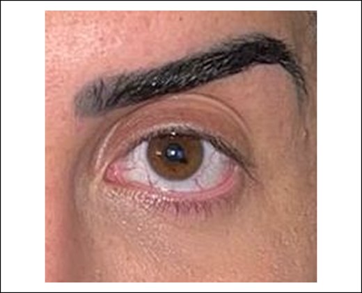 Aesthetically unideal periorbital region with scleral show, large pretarsal space, and too lateral eyebrow peak, depicted in 33-year-old female patient.