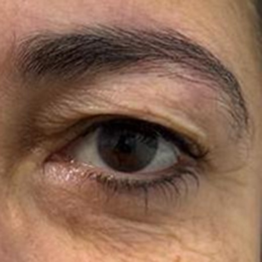 Periorbital aging depicting a falling of the end of eyebrow, negative intercanthal axis, and dermatochalasis covering the upper eyelid crease, which gives a tired appearance in a 52-year-old female patient.