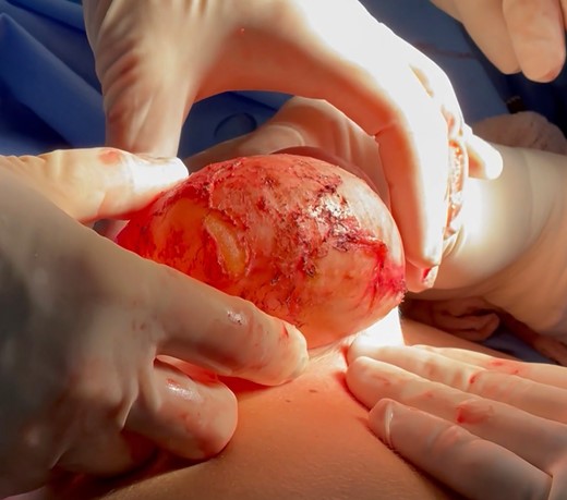 Intraoperative image depicting the explant with the peri-implant capsule during revisional surgery in a 48-year-old female patient.