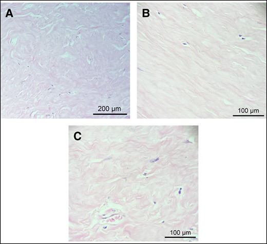 Histopathological findings of the capsular connective tissue. (A) Thick, dense bands of type I collagen without any particular alignment pattern. (B) Low cell density throughout the connective tissue of the capsule. (C) Poor vascularity of the dense connective tissue of the capsule. Representative images of hematoxylin and eosin staining of contracted (A and C) and uncontracted (B) capsules.