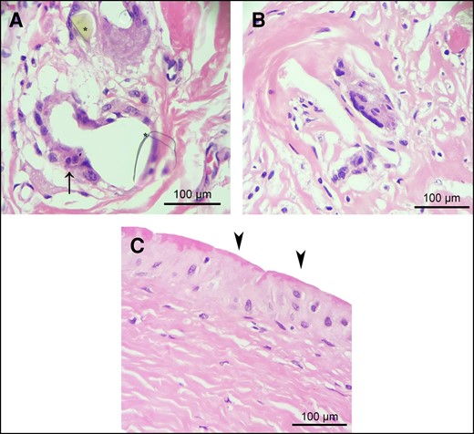 Chronic foreign body reaction and synovial metaplasia in contracted and uncontracted capsules. (A) Within the connective tissue of both types of capsules, a prevalent chronic foreign body reaction characterized by the presence of polynucleate foreign body giant cells (indicated by arrow) in association with refringent crystalline amorphous material was observed. This crystalline amorphous material is likely derived from polyurethane foam–coated implants. (B) Chronic foreign body reaction exhibiting a reduced inflammatory cell response. (C) Synovial metaplasia (arrowheads), characterized by the proliferation of synovial-like cells arranged in a palisade manner in the innermost region of the capsule directly interfacing with the polyurethane implant, was significantly more frequent in uncontracted capsules than in contracted capsules (P < .0049). Representative images of hematoxylin and eosin staining of contracted (A) and uncontracted (B and C) capsules.