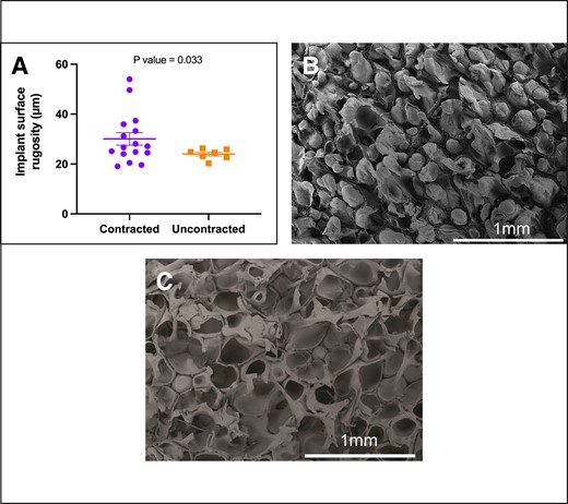 Contracture status and the surface roughness (Ra) of polyurethane foam–coated implants (Silimed). Surface roughness refers to the measurement of microirregularities found on the implant surface, as observed under scanning electron microscopy. (A) The roughness of the implant surface is significantly higher in contracted capsules (P = .033). (B) Detailed views of the surface characteristics of contracted capsules and (C) uncontracted capsules.