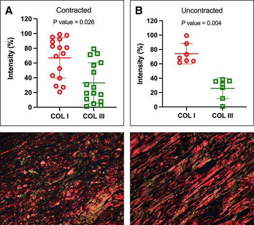 Abundance of type I and type III collagen within the capsules. Both contracted (A) and uncontracted (B) capsules exhibited a higher proportion of type I collagen than type III collagen. (C) Representative histologic sections, stained with picrosirius red and examined under polarized light microscopy, of a contracted and (D) uncontracted capsule. P values were calculated with a paired t test.