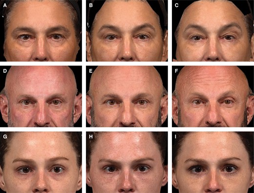 Photographic outcomes for 3 patients before and after treatment with HAEYE. Images A-C show a White, 54-year-old, postmenopausal female treated with 2.0 mL HAEYE with a needle (1.0 mL on each side). (A) Before treatment, blinded evaluator GIHS score 3 (severe, both sides); (B) at Month 3, GIHS score 1 (mild, both sides); (C) at Month 12 before retreatment, GIHS score 0 (none, right) and 1 (mild, left). Images D-F show a White, 51-year-old male treated with 4.0 mL HAEYE (2.0 mL on each side) by cannula injection. (D) Before treatment, blinded evaluator GIHS score 3 (severe, both sides); (E) at Month 3, GIHS score 1 (mild, both sides); (F) at Month 12 before retreatment, GIHS scores 2 (moderate, right), 3 (severe, left). Images G-I show a White, 26-year-old female treated with 1.8 mL HAEYE (0.8 mL on right side and 1.0 mL on left side) by needle injection. (G) Before treatment, blinded evaluator GIHS score 2 (moderate, both sides); (H) at Month 3, GIHS score 0 (none, both sides); (I) at Month 12 before retreatment, GIHS score 1 (mild, both sides). GIHS, Galderma infraorbital hollow scale.