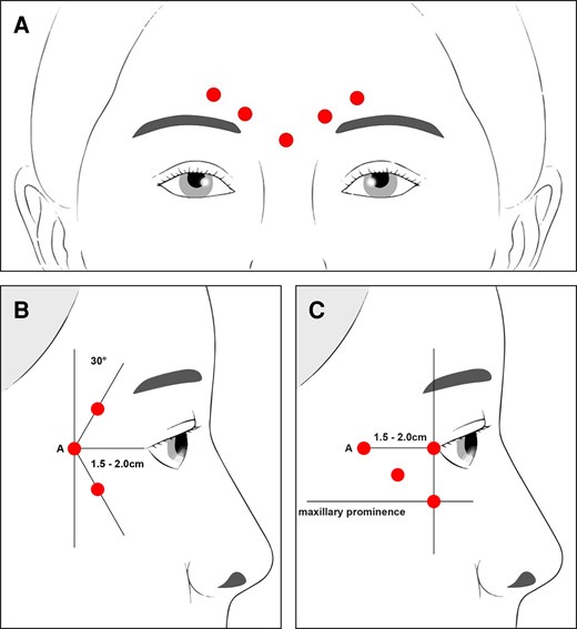 Locations of the 5 glabellar line injections (A). Lateral canthal line injection pattern when lateral canthal lines are distributed above and below the lateral canthus (B); and lateral canthal line injection pattern when lateral canthal lines are primarily distributed below the lateral canthus (C).