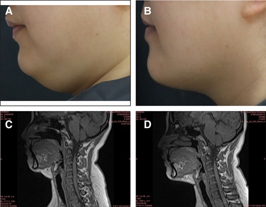 A 38-year-old female treated with MEI005. (A) and (B) reveal pretreatment and improved jawline contour, respectively, at 12 weeks after the fourth treatment session (Week 12), whereas (C) and (D) reveal reduced submental fat volume on MRI at the same time points.