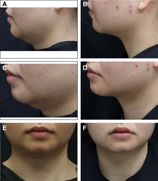 Representative case receiving MEI005 injection. (A, C, E) Lateral, frontal, and oblique views of the jawline contour of a 26-year-old female at baseline, and (B, D, F) the corresponding views 12 weeks after the third treatment session.