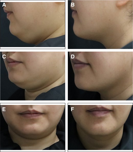 Representative case receiving MEI005 injection. (A, C, E) Lateral, frontal, and oblique views of the jawline contour of a 38-year-old female at baseline, and (B, D, F) the corresponding views 12 weeks after the fourth treatment session.