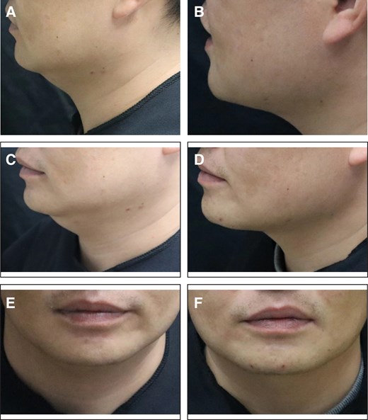 Representative case receiving MEI005 injection. (A, C, E) Lateral, frontal, and oblique views of the jawline contour of a 34-year-old male at baseline, and (B, D, F) the corresponding views 12 weeks after the third treatment session.