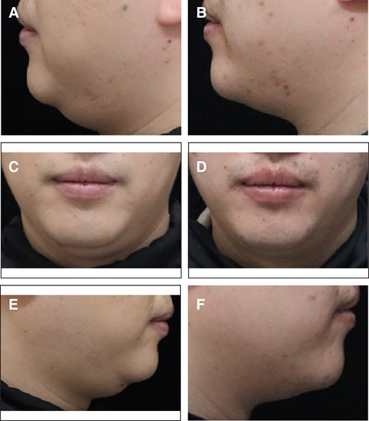 Representative case receiving MEI005 injection. (A, C, E) Lateral and frontal views of the jawline contour of a 32-year-old male at baseline, and (B, D, F) the corresponding views 12 weeks after the fourth treatment session.