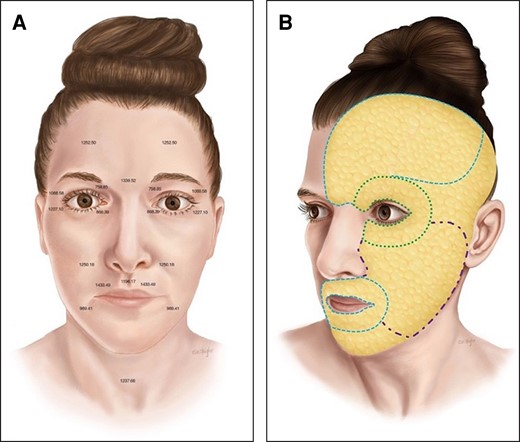 (A) Topographical variations in dermal thickness. The thickness of the skin varies based on the anatomical area of the face. A surgeon's understanding of dermis topographical anatomy is important for adjusting treatment depth with radiofrequency devices. Average dermal thickness (μm) of key treatment zones is presented here (adapted with permission from Chopra et al, ASJ 2015). (B) Topographic variations in subcutaneous fat thickness. When applying FaceTite, surgeons must appreciate the topographical variations in subcutaneous fat thickness of the face. Orienting the bipolar probe safely and with maximal treatment effect requires an understanding of the relative thickness of facial fat across the face (periorbita (green), very thin; forehead and perioral region (blue), thin; malar eminence/cheek (purple), moderate thickness.